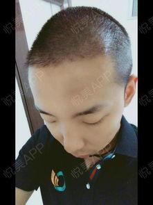 毛发种植视频,从视频看植发全过程